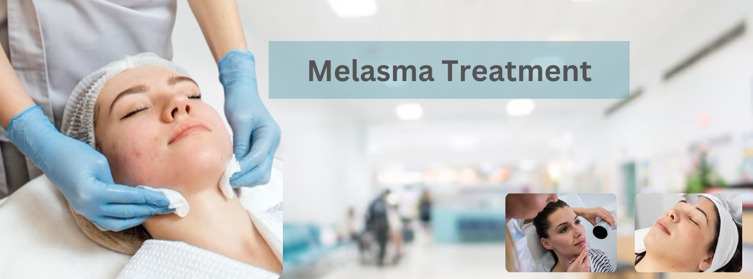 Melasma Treatment in Janakpuri Delhi